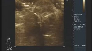 Гемангиома носа на УЗИ