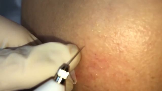 Плазменный Коагулятор KS 12 смотреть онлайн