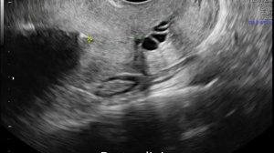 Экспульсия и инверсия внутриматочной спирали