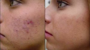 Роаккутан до и после