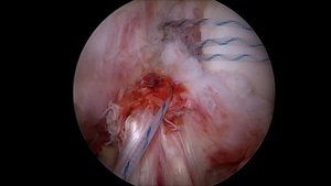 Шов передней крестообразной связки (ПКС). Рефиксация к бедру. Самиленко И.Г. www.artro-s.ru