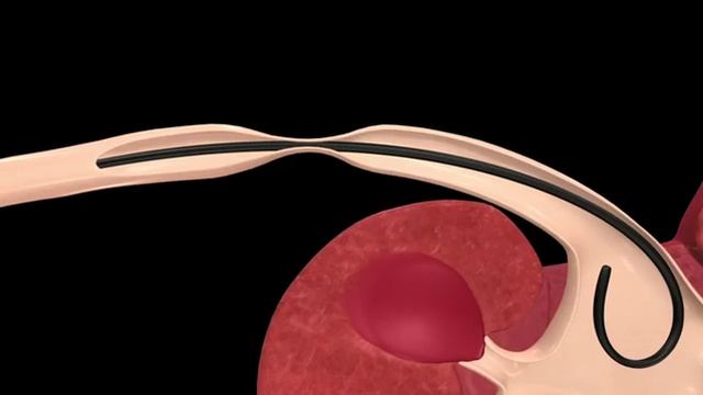 Баллонный катетер Ascend™AQ®для расширения мочеточника смотреть онлайн