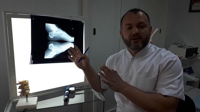 Пяточная шпора. Боровской Евгений — врач ортопед-травматолог смотреть онлайн