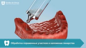 Имплантация зубов ALL ON 6 при атрофии костной ткани