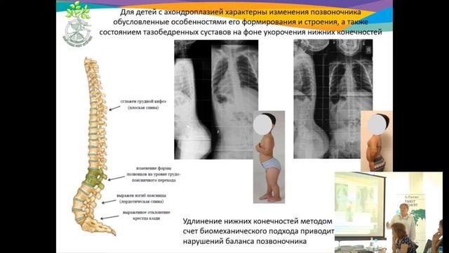 Круглый стол 2018. Доклад о лечении методом Илизарова. Анна Аранович.