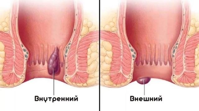 Геморрой