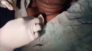 粉刺 粟粒腫  давить прыщи Черные точки Dermatologist video to press pimples Тебя стошнит от этого видео