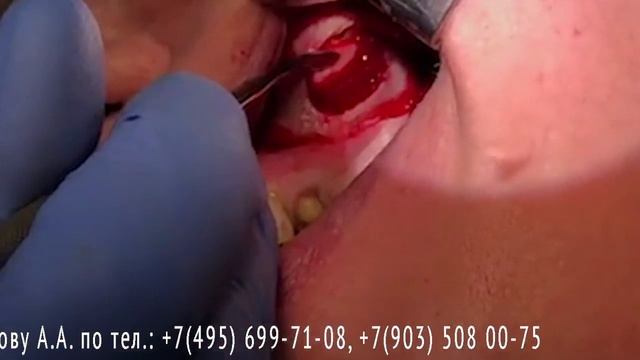 Синуслифтинг с левой стороны. Профессор Орлов А.А. смотреть онлайн