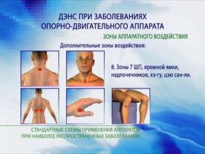 ДЭНАС и Заболевания опорно двигательного аппарата