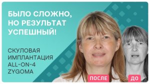 Скуловая имплантация all-on-4 NobelZygoma: было ли больно? Отзыв пациента