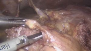 Лапароскопическая гастрэктомия + ЛАЭ D2. Laparoscopic gastrectomy