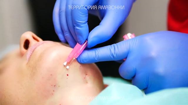 Убираем второй подбородок - нитевой лифтинг в Москве