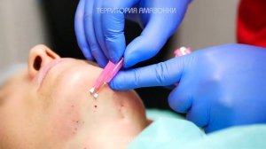 Убираем второй подбородок - нитевой лифтинг в Москве