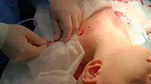 Постановка подкожной порт-системы ребенку с онкологическим заболеванием