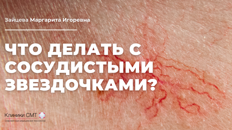 Сосудистые звездочки: причины, лечение и советы от Клиники СМТ