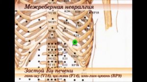 точки при  межреберной невралгии
