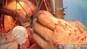 Протезирование митрального клапана / Mitral valve replacement