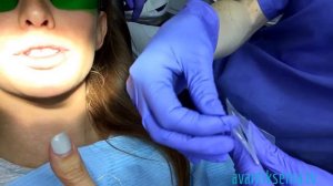 Снятие брекетов: больно или нет?