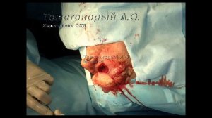 Удаление базальноклеточной карциномы