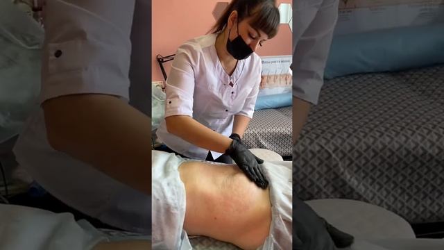 Холодная Плазма. Подтяжка живота и уменьшение объёмов.