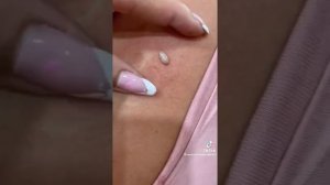 Popping huge blackheads and pimple popping - Best Pimple Popping Videos #2