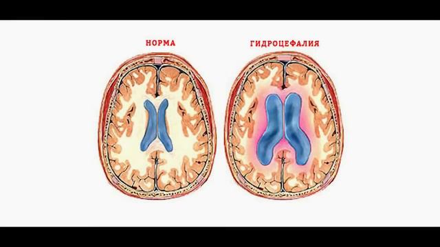 ГИДРОЦЕФАЛИЯ [Шокирующая реальность #9] смотреть онлайн