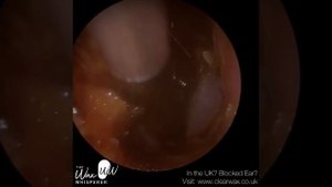 1,162 - American Nurse Ear Wax Removal