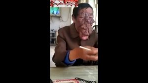 Опухоль лица / Facial tumor