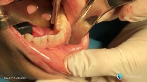 Mandibular Tori (surgery)(Removal)