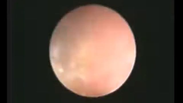 КЛТ лазерная верхняя треть мочеточника avi