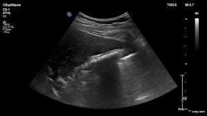 УЗИ желчного пузыря. Нефункционирующий желчный пузырь с конкрементами.