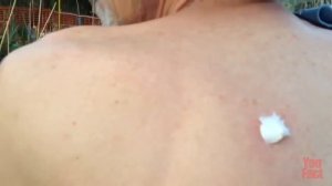 Что делать если вас укусил клещ