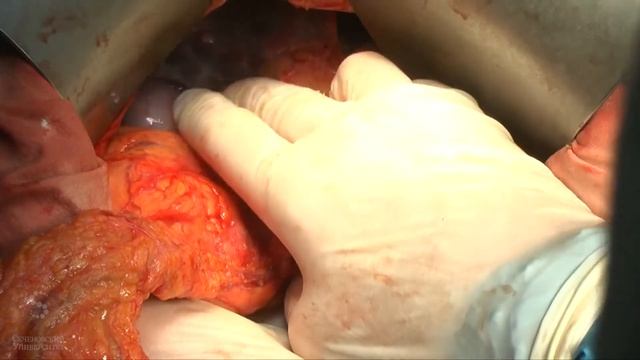 Open right colectomy / Открытая правосторонняя гемиколэктомия с Д-3 лимфодиссекцией / Царьков П.В.