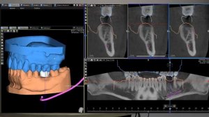 3Diagnosys и PlastyCAD - планирование одиночного имплантата+ хирургического шаблона