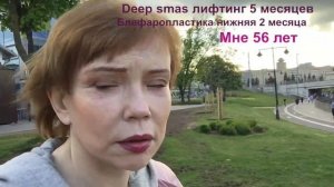 Deep smas лифтинг 5 месяцев, блефаропластика 2 месяца