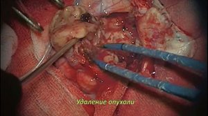 Удаление продолженного роста глиобластомы левой лобной доли