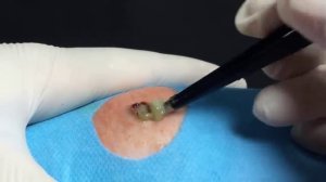 BEST Pimple Popping // Big Cystic Acne Blackheads // Whiteheads Removal / Squeezing Pimples / He#01