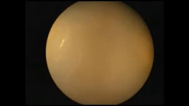 Субмукозная миома смотреть онлайн