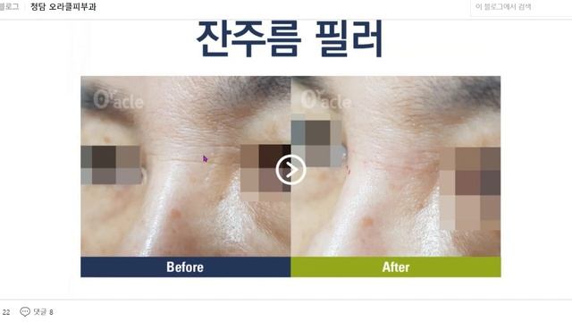 눈가 잔주름에 가장 효과적인 치료법은? смотреть онлайн