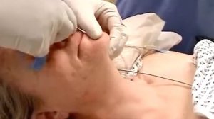 Назальная интубация