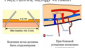 Сосудистый доступ для гемодиализа-1: Венопункция