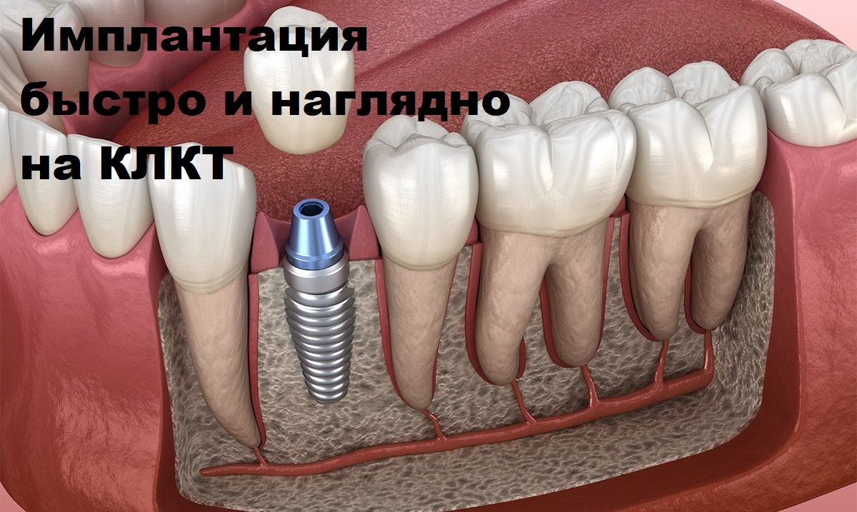 Имплантологу. Экспресс-замеры и виртуальная имплантация.