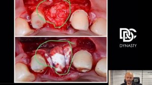 Аугментация кости по методу (IDR) во фронтальном отделе.