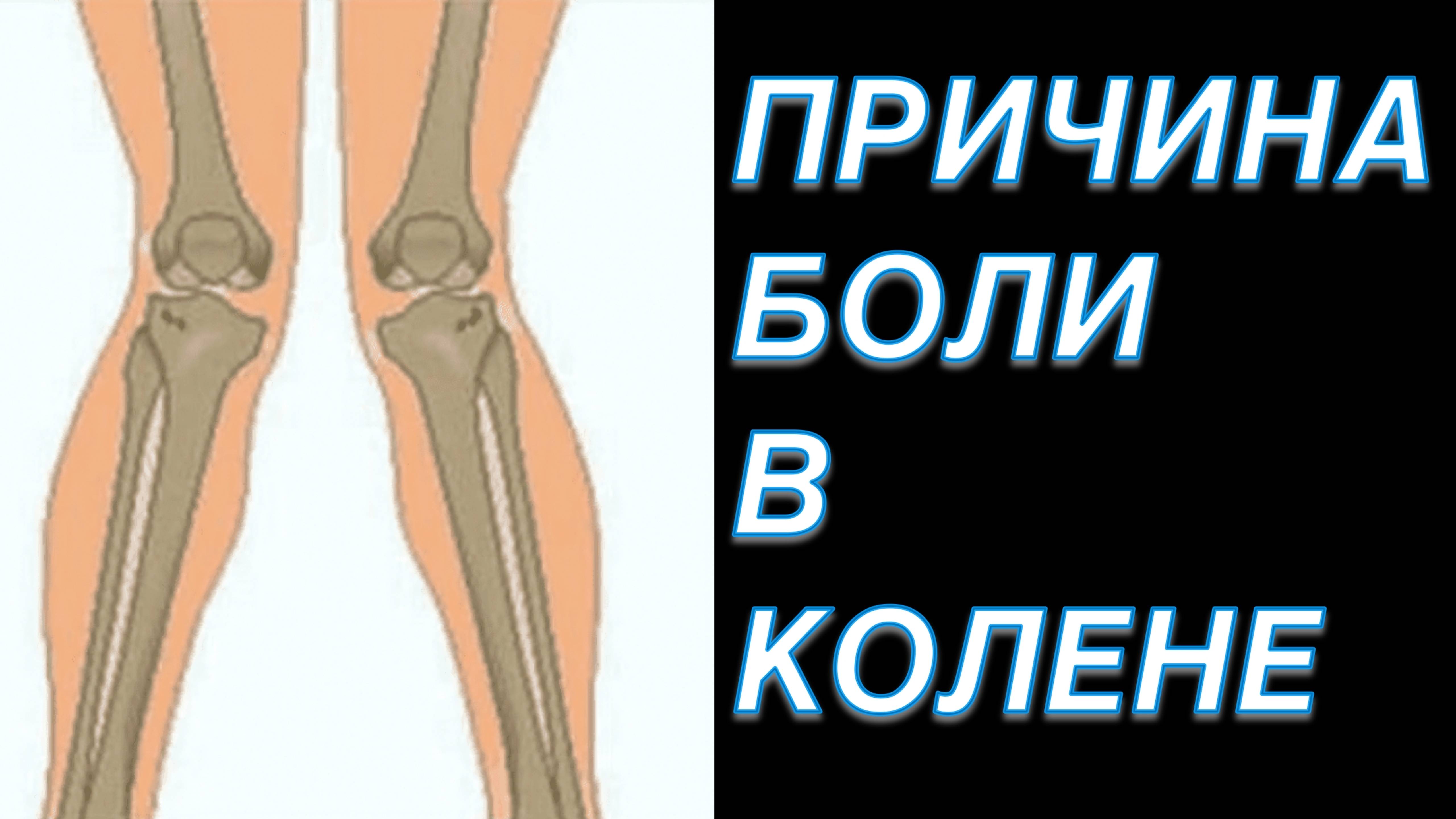 САМАЯ ЧАСТАЯ ПРИЧИНА БОЛИ В КОЛЕНЕ | Динамический Вальгус