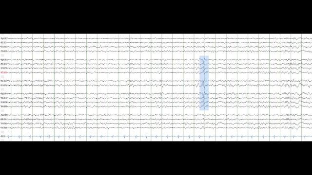 1 стадия NREM фазы в ЭЭГ смотреть онлайн