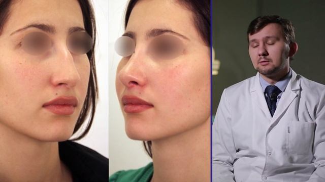 Сколько времени займет реабилитация после ринопластики