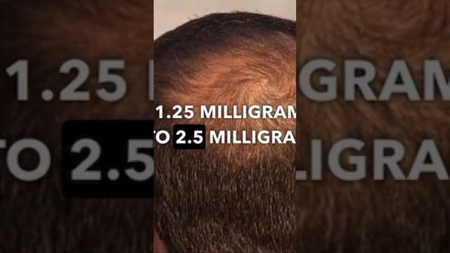 hairgrowth The best and safest products for men hair loss ? Androgen alopecia!?