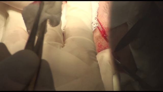 ИССЕЧЕНИЕ РУБЦА смотреть онлайн