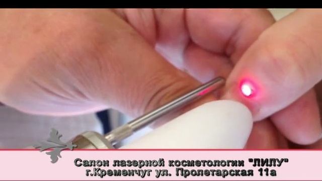 Удаление бородавки лазером салон Лилу в Кременчуге смотреть онлайн