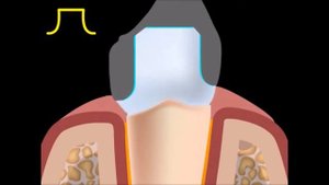 Препарирование зуба под металлокерамическую коронку. Металлокерамика.